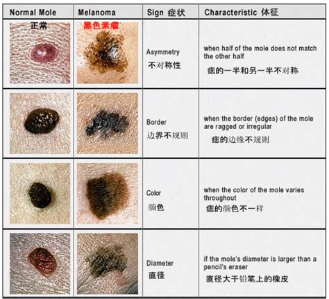 黑色的痣|有这5种“痣”要小心，可能会恶变